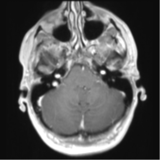 File:Chiari I malformation and obstructive hydrocephalus (Radiopaedia 41185-43978 Axial T1 C+ 9).png