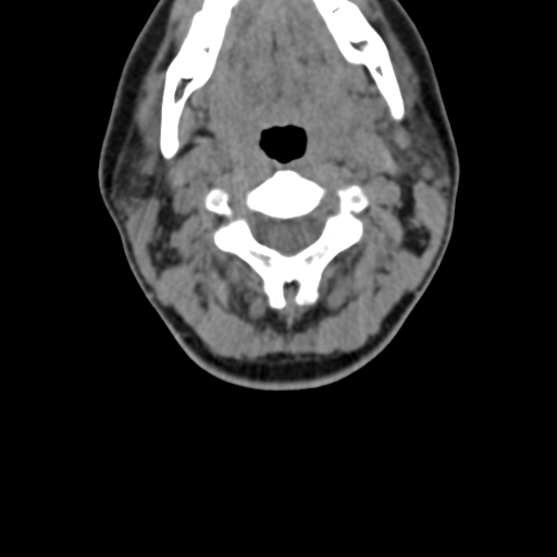 File:Chiari I malformation and obstructive hydrocephalus (Radiopaedia 41185-43981 D 42).png