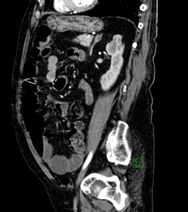 Cholangiocarcinoma with cerebral metastases (Radiopaedia 83519-98629 F 45).jpg
