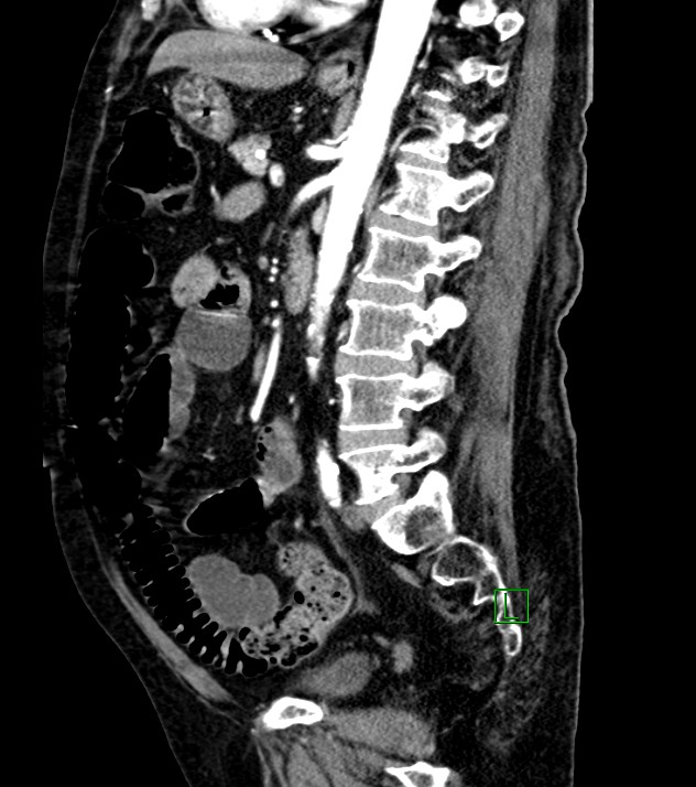 Cholangiocarcinoma with cerebral metastases (Radiopaedia 83519-98629 F 55).jpg