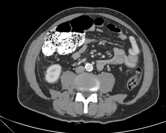 File:Cholecystitis - perforated gallbladder (Radiopaedia 57038-63916 A 48).jpg