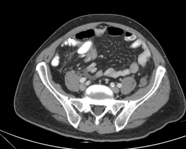 File:Cholecystitis - perforated gallbladder (Radiopaedia 57038-63916 A 60).jpg