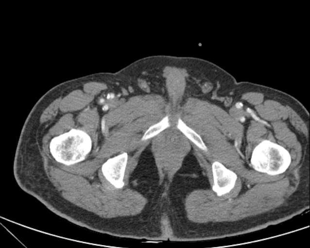 Cholecystitis - perforated gallbladder (Radiopaedia 57038-63916 A 85).jpg