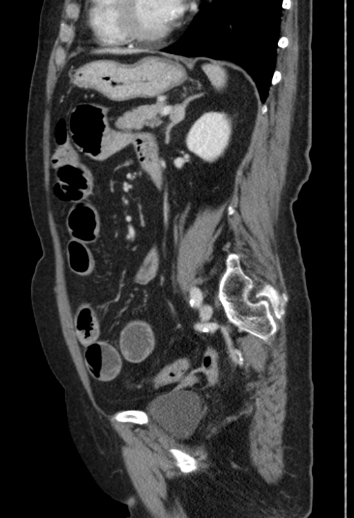 Cholecystoduodenal fistula due to calculous cholecystitis with gallstone migration (Radiopaedia 86875-103077 F 22).jpg