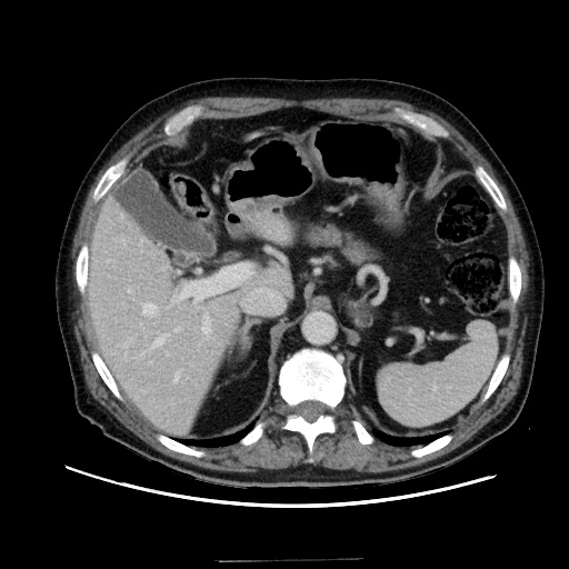 Choledocholiathiasis with normal caliber common bile duct (Radiopaedia 75368-86632 A 55).jpg