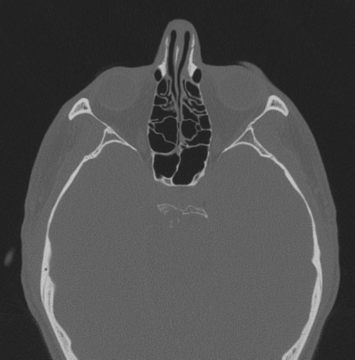 Chondrosarcoma (clivus) (Radiopaedia 46895-51425 Axial bone window 33).png