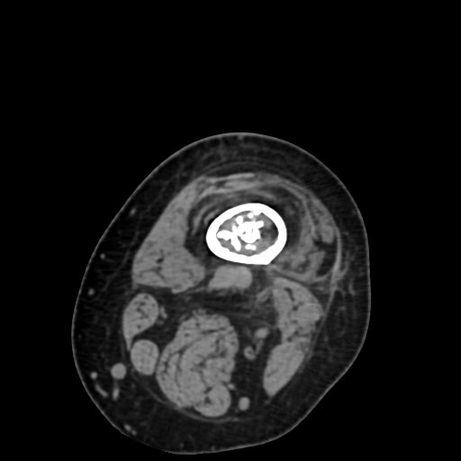 Chondrosarcoma - femur (Radiopaedia 64187-72954 Axial non-contrast 12).jpg