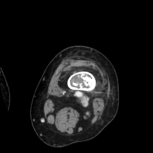 Chondrosarcoma - femur (Radiopaedia 64187-72954 Axial with contrast 21).jpg