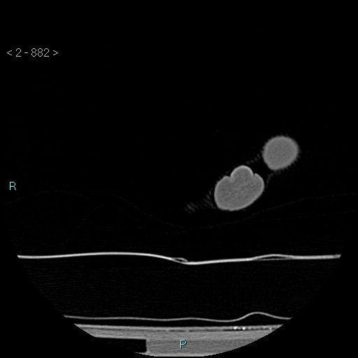 File:Chondrosarcoma - phalanx (Radiopaedia 69047-78812 Axial bone window 136).jpg