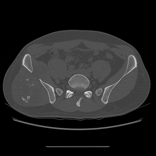 File:Chondrosarcoma of iliac wing (Radiopaedia 63861-72599 Axial bone window 47).jpg