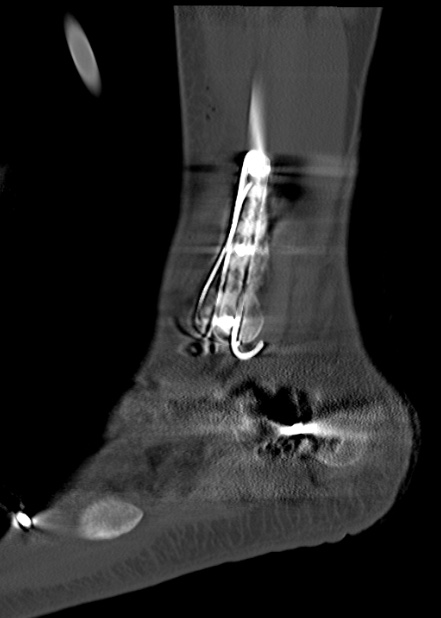 Chopart fracture (Radiopaedia 35347-36861 Sagittal bone window 58).jpg