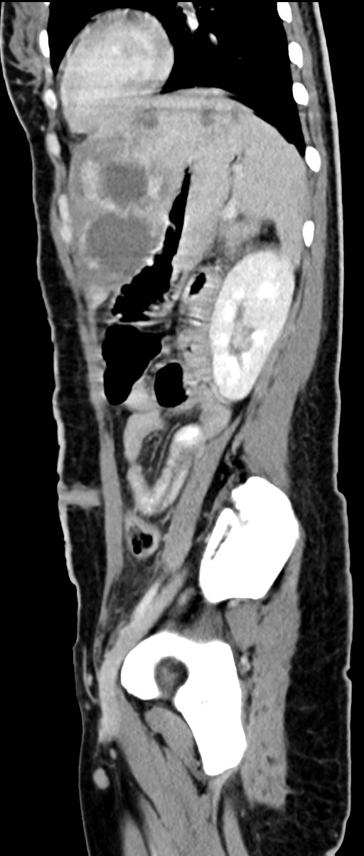 Choriocarcinoma liver metastases (Radiopaedia 74768-85766 C 70).jpg
