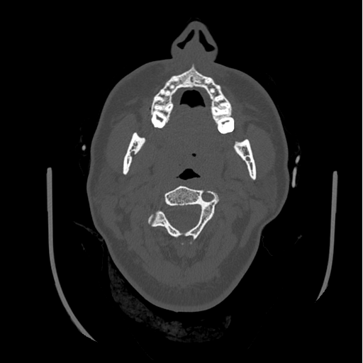 Choroid plexus papilloma extending into the cerebellopontine angle cistern (Radiopaedia 85941-101833 Axial bone window 1).png