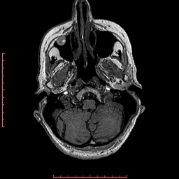 File:Choroid plexus xanthogranuloma (Radiopaedia 67843-77270 Axial T1 136).jpg