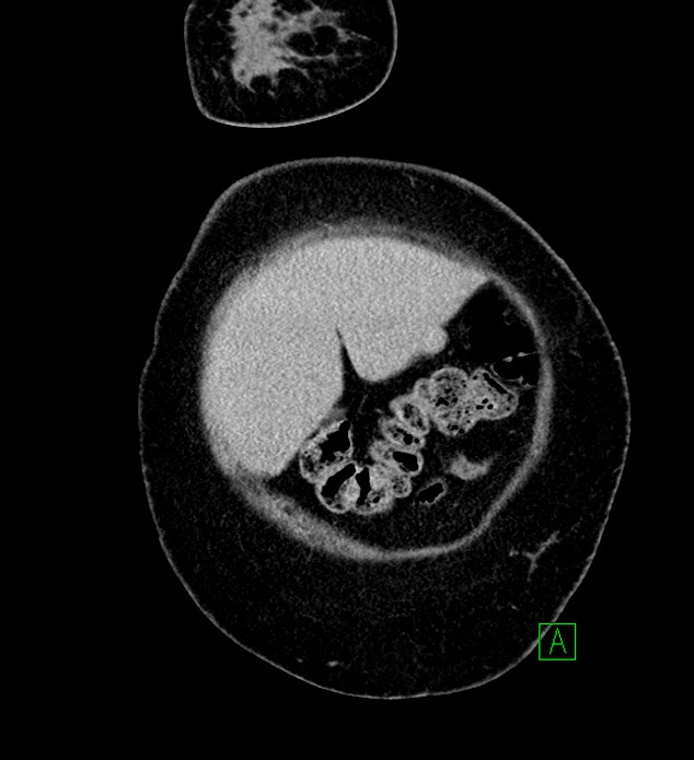 Chromophobe renal cell carcinoma (Radiopaedia 84239-99519 F 10).jpg