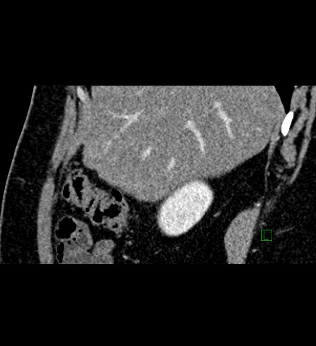 Chromophobe renal cell carcinoma (Radiopaedia 84286-99573 F 138).jpg