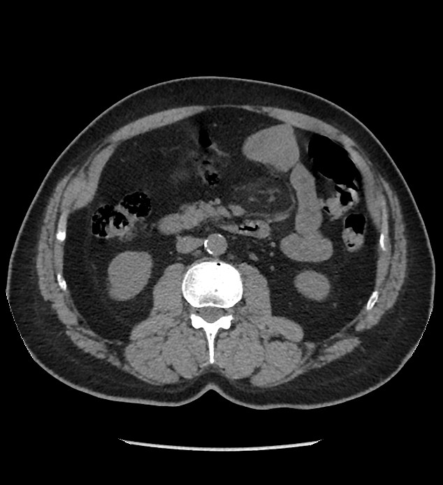 Chromophobe renal cell carcinoma (Radiopaedia 86879-103083 Axial non-contrast 48).jpg