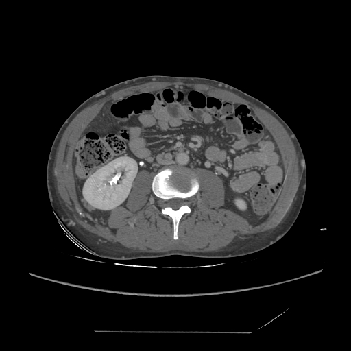 File:Chronic IVC thrombosis and resultant IVC filter malposition (Radiopaedia 81158-94800 A 112).jpg