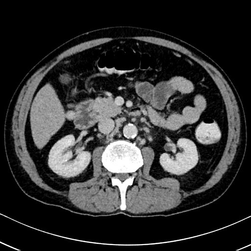 Chronic appendicitis complicated by appendicular abscess, pylephlebitis and liver abscess (Radiopaedia 54483-60700 B 68).jpg