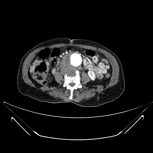 File:Chronic contained rupture of abdominal aortic aneurysm with extensive erosion of the vertebral bodies (Radiopaedia 55450-61901 A 35).jpg