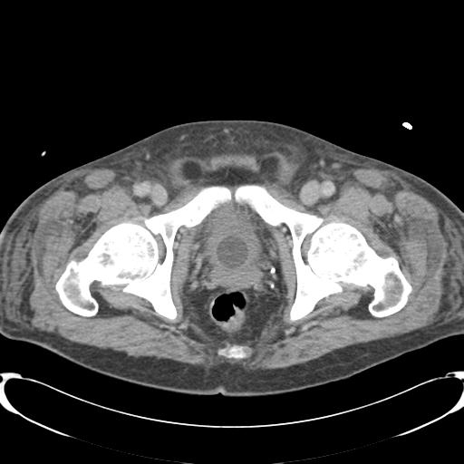 Chronic diverticulitis complicated by hepatic abscess and portal vein thrombosis (Radiopaedia 30301-30938 A 89).jpg