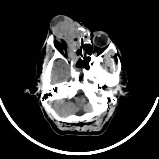 File:Chronic invasive fungal sinusitis with intraorbital and intracranial extension (Radiopaedia 56387-63046 Axial non-contrast 114).jpg