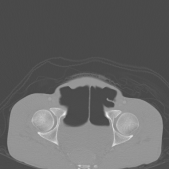 Chronic large bowel pseudo-obstruction (Radiopaedia 43181-46492 Axial bone window 154).jpg