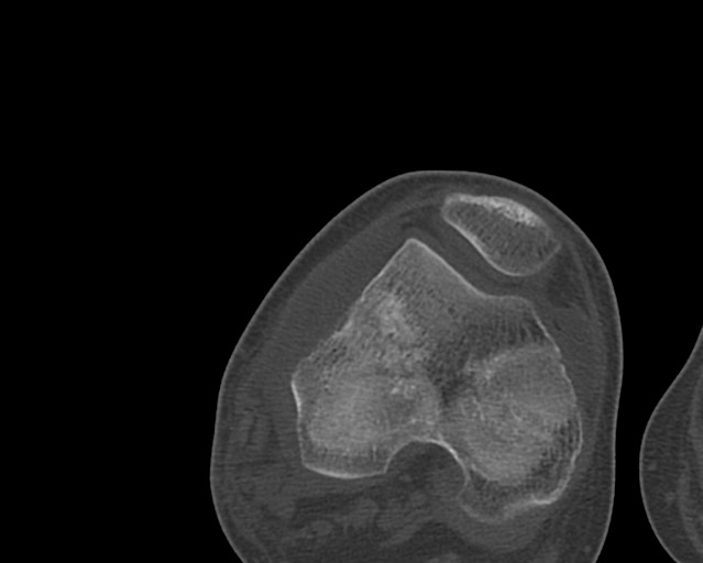 Chronic ostemyelitis of the femur with long sinus tract (Radiopaedia 74947-85982 Axial bone window 215).jpg