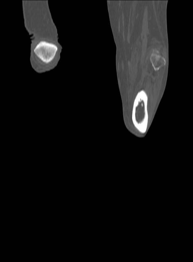 Chronic osteomyelitis - tibia (with sequestrum) (Radiopaedia 73273-84090 Coronal non-contrast 64).jpg