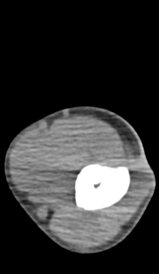 Chronic osteomyelitis of the distal humerus (Radiopaedia 78351-90971 Axial non-contrast 69).jpg