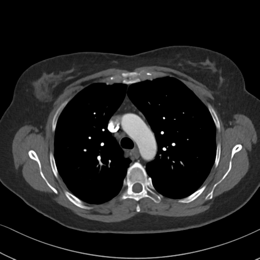 Chronic pulmonary embolus (Radiopaedia 39129-41341 Axial C+ CTPA 35).png
