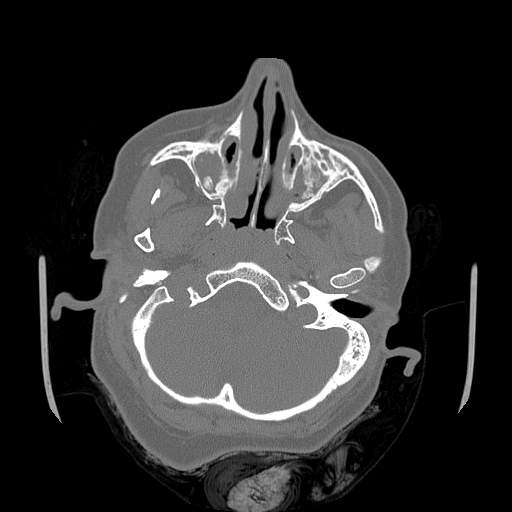 Chronic sinusitis with intra-sinus calcification (Radiopaedia 63919-72668 Axial bone window 53).jpg