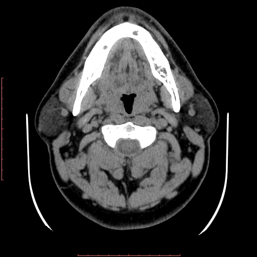 Chronic submandibular sialolithiasis (Radiopaedia 69817-79814 Axial non-contrast 88).jpg