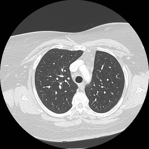 Cicatrisation collapse (Radiopaedia 17405-17089 lung window 34).jpg