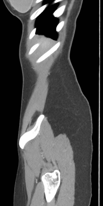 Circumaortic left renal vein with a duplicated retroaortic vein (Radiopaedia 91668-109398 C 118).jpg
