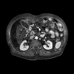 Cirrhosis and hepatocellular carcinoma in the setting of hemochromatosis (Radiopaedia 75394-86594 Axial T1 C+ fat sat 194).jpg
