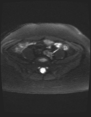 File:Class II Mullerian duct anomaly- unicornuate uterus with rudimentary horn and non-communicating cavity (Radiopaedia 39441-41755 Axial DWI 3).jpg