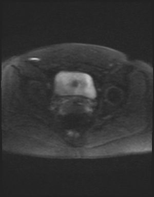 Class II Mullerian duct anomaly- unicornuate uterus with rudimentary horn and non-communicating cavity (Radiopaedia 39441-41755 Axial DWI 51).jpg