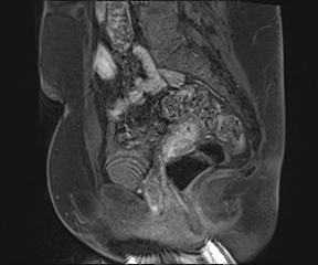 Class II Mullerian duct anomaly- unicornuate uterus with rudimentary horn and non-communicating cavity (Radiopaedia 39441-41755 G 55).jpg