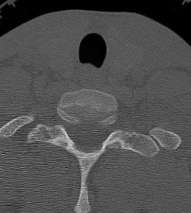 Clay-shoveler fracture (Radiopaedia 14604-14532 Axial bone window 50).jpg