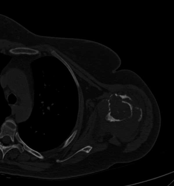 Clear cell chondrosarcoma - humerus (Radiopaedia 63104-71612 Axial bone window 58).jpg