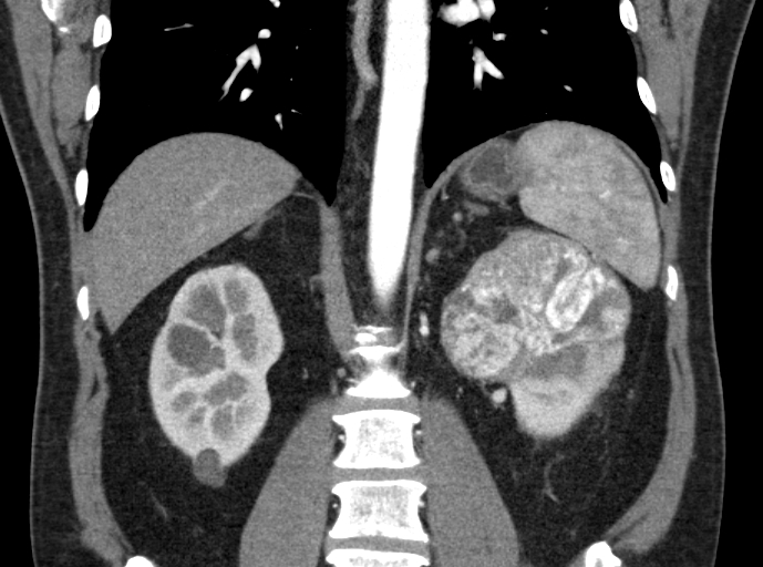 File:Clear cell renal cell carcinoma (Radiopaedia 61449-69393 C 28).jpg