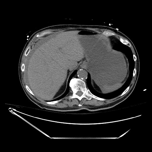 File:Closed loop obstruction due to adhesive band, resulting in small bowel ischemia and resection (Radiopaedia 83835-99023 Axial non-contrast 32).jpg