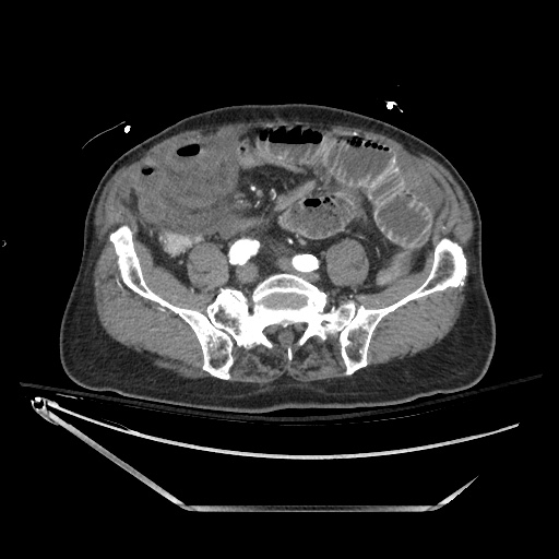 Closed loop obstruction due to adhesive band, resulting in small bowel ischemia and resection (Radiopaedia 83835-99023 B 106).jpg