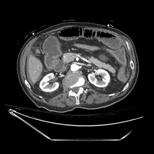 Closed loop obstruction due to adhesive band, resulting in small bowel ischemia and resection (Radiopaedia 83835-99023 B 58).jpg