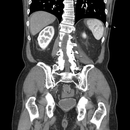 Closed loop obstruction due to adhesive band, resulting in small bowel ischemia and resection (Radiopaedia 83835-99023 C 92).jpg