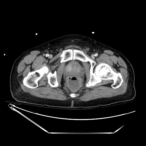 File:Closed loop obstruction due to adhesive band, resulting in small bowel ischemia and resection (Radiopaedia 83835-99023 D 153).jpg
