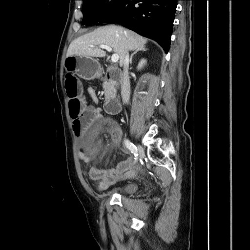 File:Closed loop obstruction due to adhesive band, resulting in small bowel ischemia and resection (Radiopaedia 83835-99023 F 79).jpg