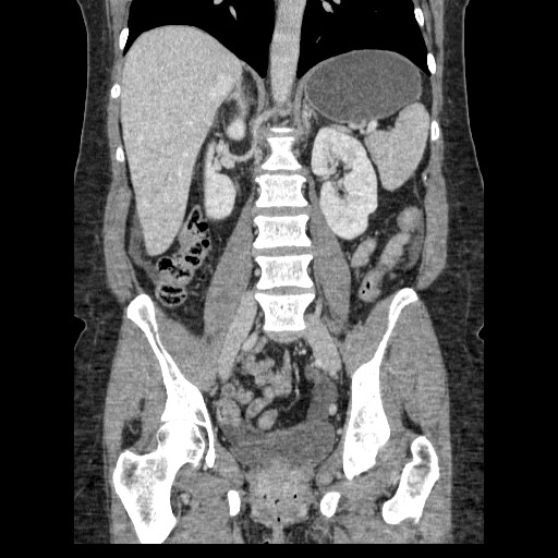 Closed loop small bowel obstruction (Radiopaedia 65403-74451 B 66).jpg