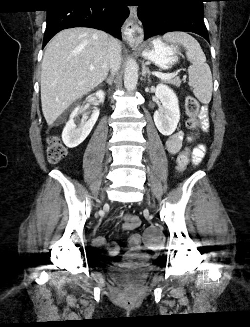 Closed loop small bowel obstruction - adhesions (Radiopaedia 59078-66369 B 74).jpg